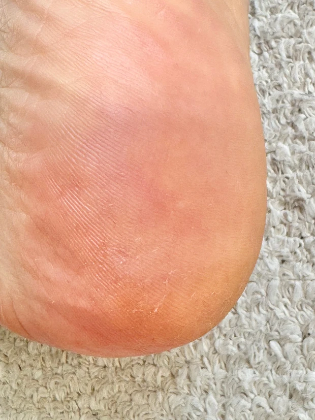 【検証】オルビスのディフェンセラでガサガサかかとがつるんとなるまでの4ヶ月を記録！_4_2