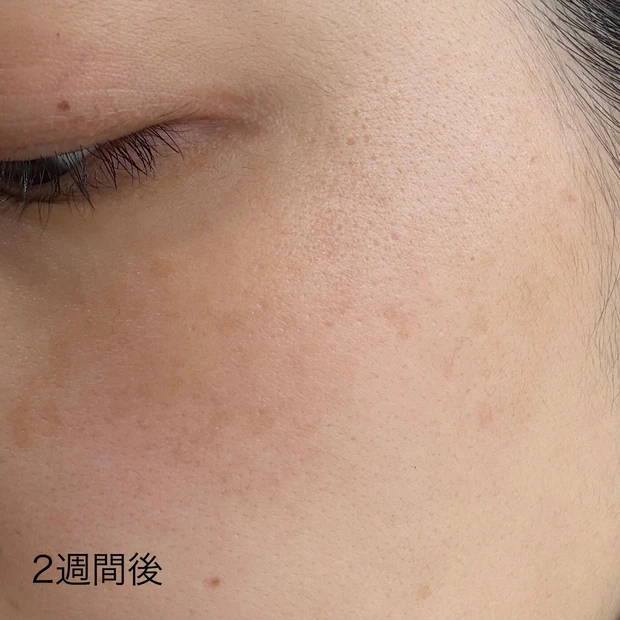 【3万円台✖️1回でも効果実感】はじめての美容医療。ルビーフラクショナルDT記録。_7_2