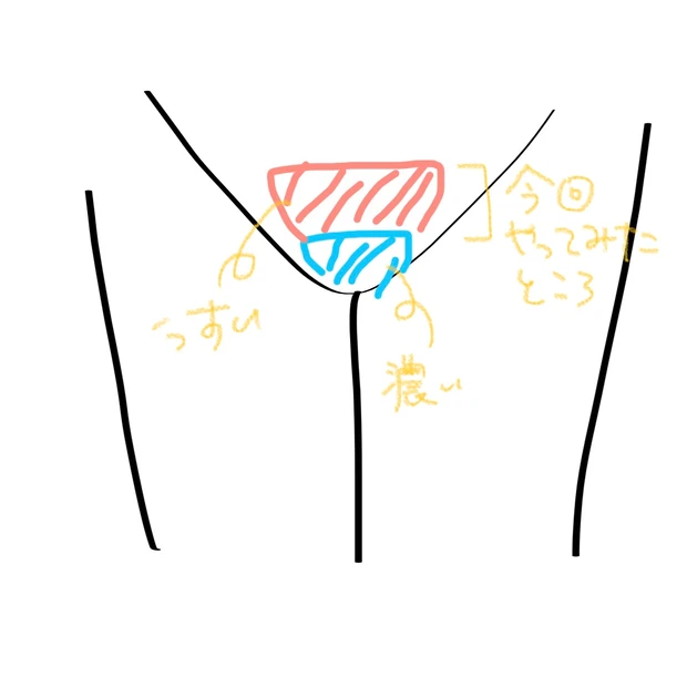 2ヶ月自宅でVIO脱毛を頑張ったので成果を聞いてほしい【トリア・ユーライク】_3