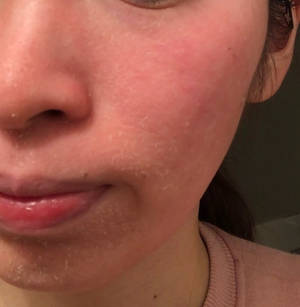 【ゼオスキンヘルス】剥け剥け生活3ヶ月終了しました！~体験報告~_4_2