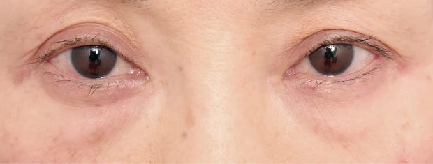 茶くまにおすすめの美容医療の治療 ヒアルロン酸注入 ビフォー