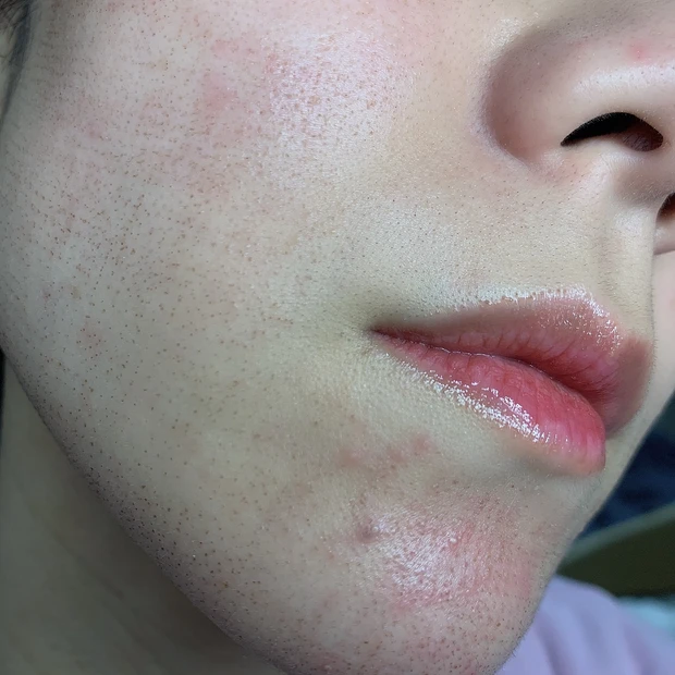 エリシスセンス ダウンタイム 2日目 経過