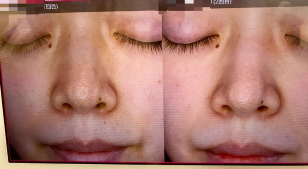 【30代で美容医療デビュー2】カスタマイズレーザー治療[２回目］施術1ヶ月後の結果レポート_2