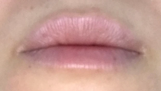 美容皮膚科施術「ピコスポット」_6_1