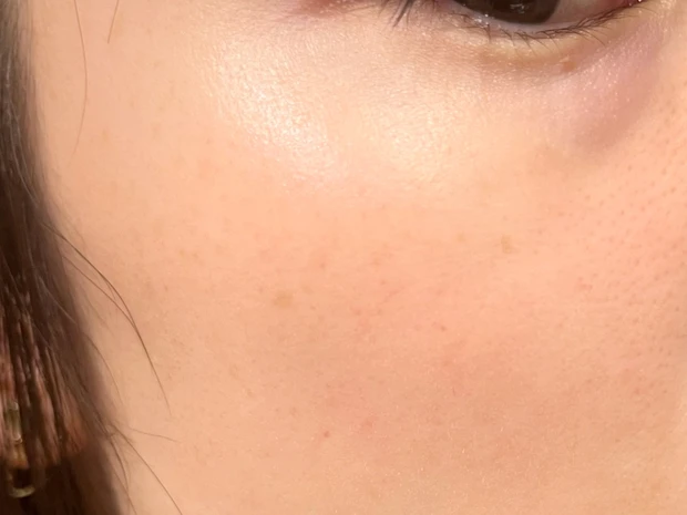 ルメッカ照射後