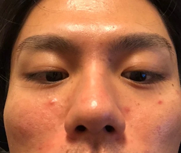 【アラサー美容男子が語る】夏のニキビ、どう対策してる？実践的ケアと日常習慣💡_1