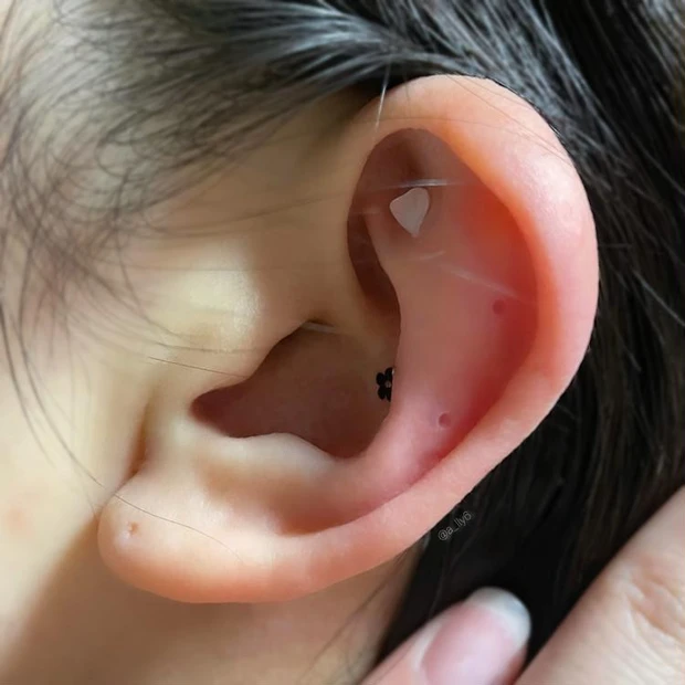 10日後、耳ツボジュエリーを剥がすと