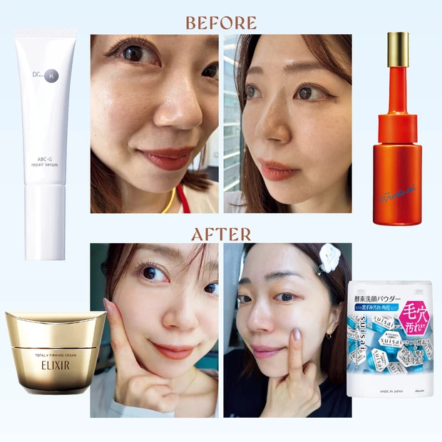 【たるみ毛穴タイプ】プロ伴走の30日間毛穴ケアマラソン、毛穴はどう変わった?