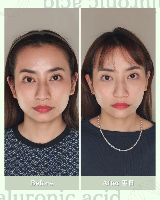 AYAMI_ヒアルロン酸注入_美容医療_真山綾美