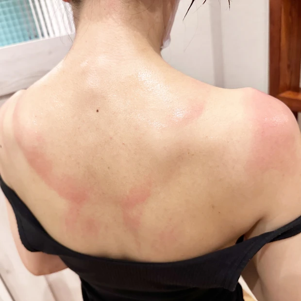 うっかり日焼け