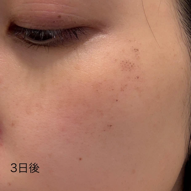 ルビーフラクショナル 3日後
