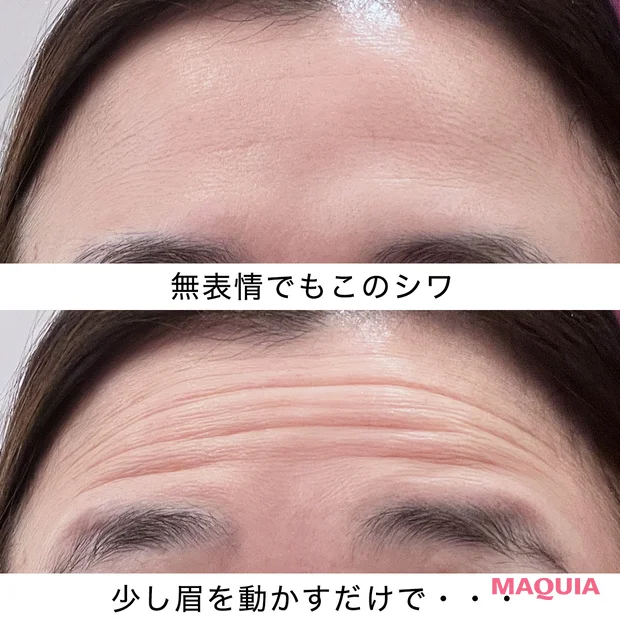 【人生初のボトックス体験記】ビビリの40代美容エディターが挑戦！直後・2週間後・１か月後どうなる？_2