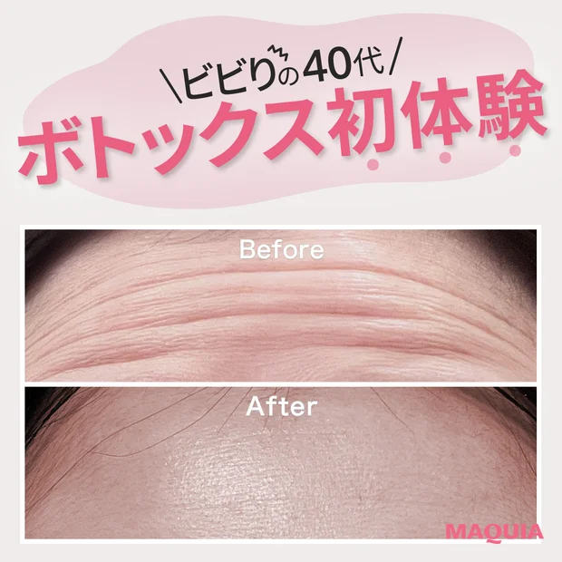 40代　ボトックス　ボトックス注射　ビフォー＆アフター