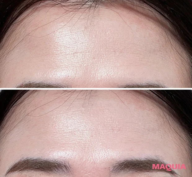 40代　ボトックス　１ヶ月後　効果