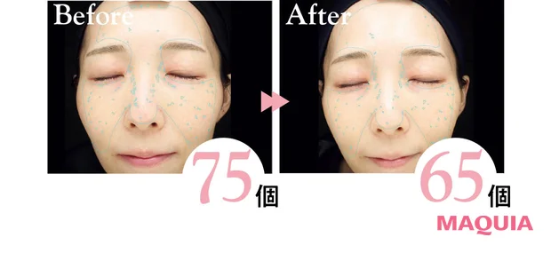 2026年おすすめブライトニング最新作 ポーラ ホワイトショット クリアスキンローション 使用後の表面シミの変化