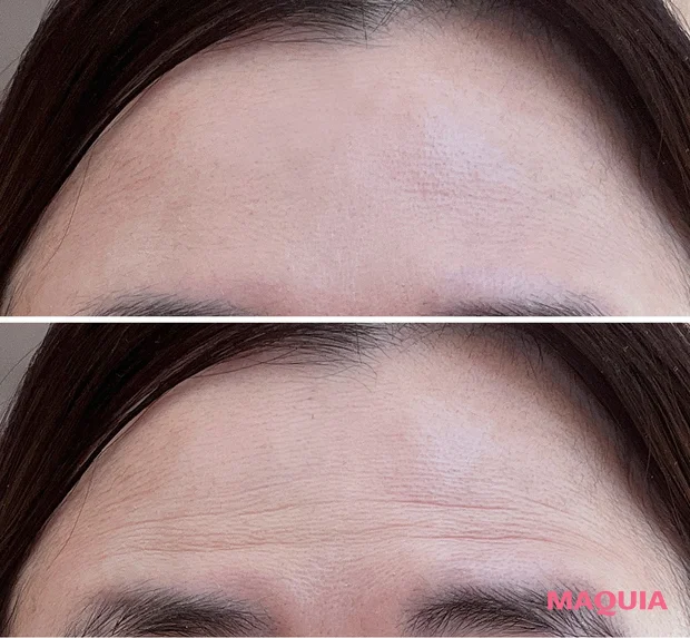 40代　ボトックス注射　施術後　効果