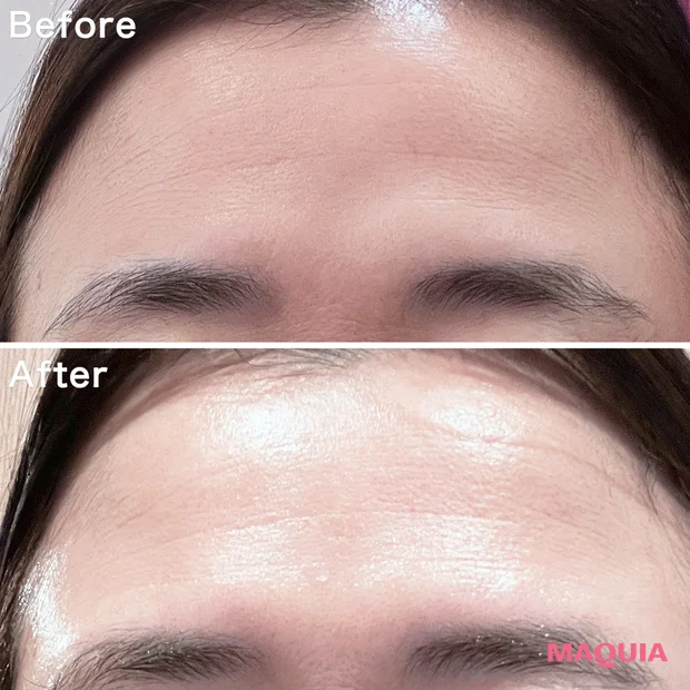 40代　額　ボトックス　背術直後