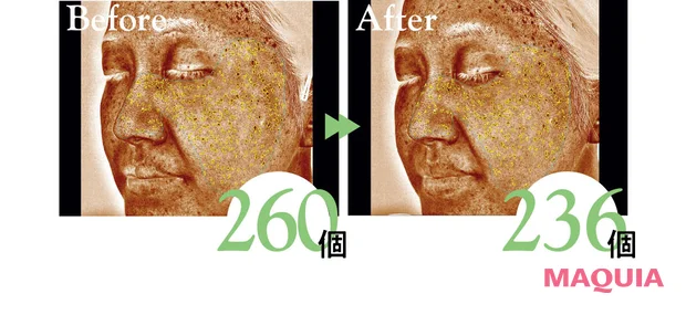 2026年最新作おすすめのブライトニング美容液 30日間使用ビフォーアフター シミの個数の変化 ONE BY KOSÉ メラノショット P