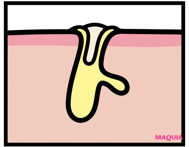 詰まり毛穴には、アゼライン酸配合コスメをピンポイントに投入。見直すべきNGケアも_2