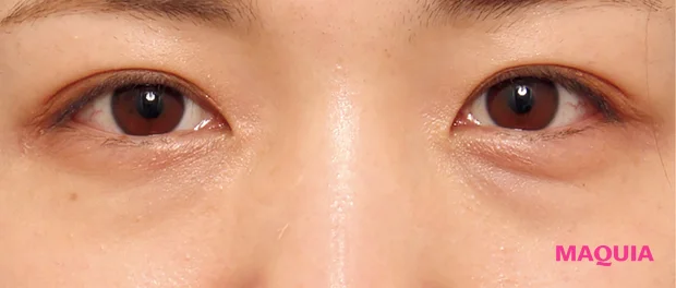 紫くまにおすすめの美容医療の治療 ベビーコラーゲン注射 ビフォー