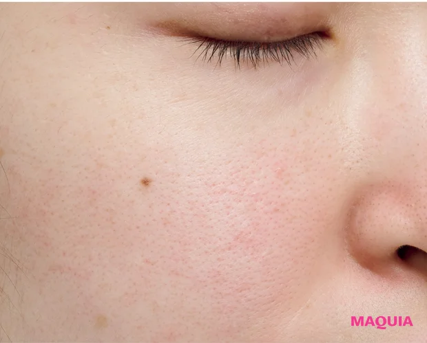 炎症による「ダメージ毛穴」は鎮静が最優先! ビタミンCのシートマスクも有効_7_1