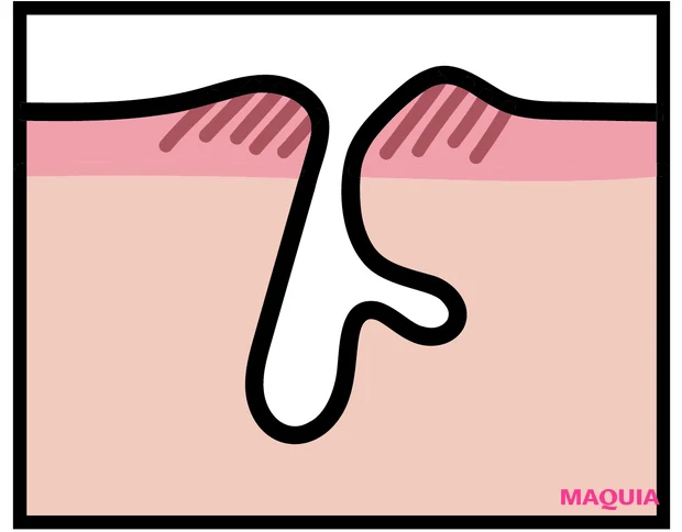 炎症による「ダメージ毛穴」は鎮静が最優先! ビタミンCのシートマスクも有効_2