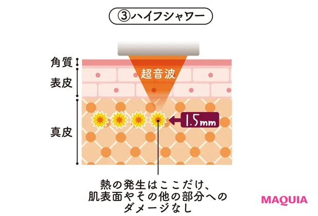 ハイフシャワーの特徴