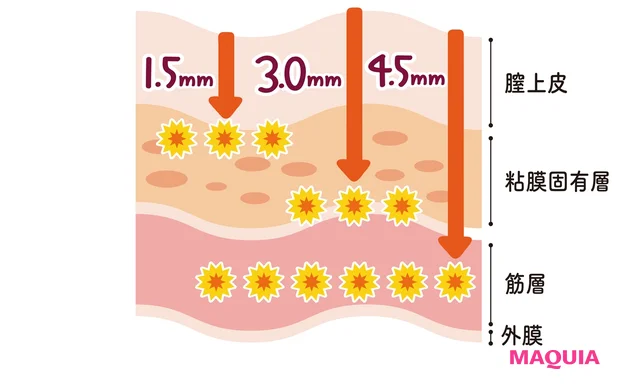 ヴィーナスハイフの仕組み