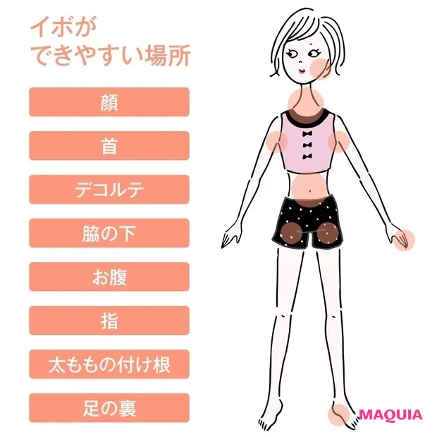 首まわりにポツポツできる「イボ」はどうすればいい？ 専門家が大人女子のお悩みに答えます！