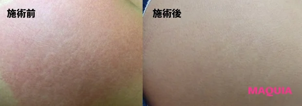 一度できてしまったらもう消えない？  『肉割れ』ができる原因と対策を徹底リサーチ！_6