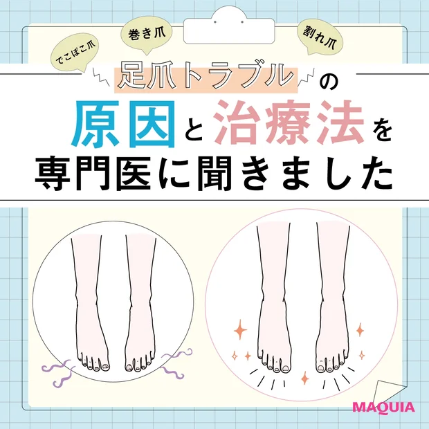 巻き爪 割れ爪 でこぼこ爪 足爪トラブルの原因と治療法を専門医に聞きました Happy Plus ハピプラ 巻き爪 割れ爪 でこぼこ爪 足爪トラブルの原因と治療法を専門医に聞きました Happy Plus ハピプラ