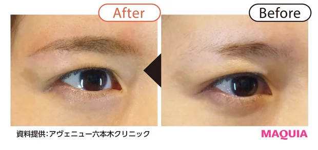 Before/After