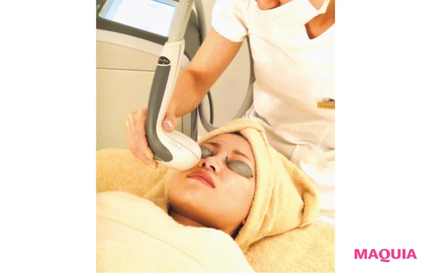 ダメージレベル2はIPL治療