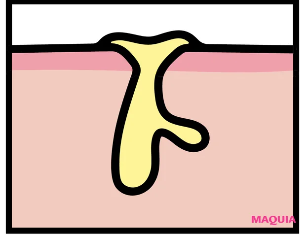 皮脂過多による「開き毛穴」に効くお手入れは？ ビタミンC＆摩擦レスの“攻めないケア”が正解_2