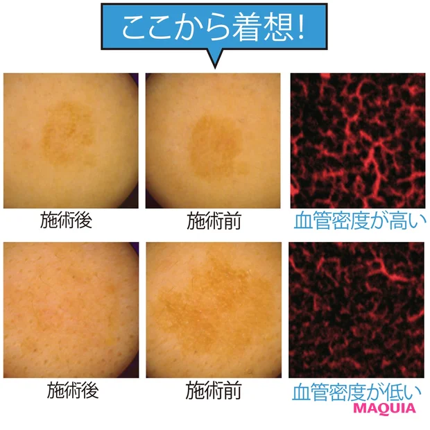 シミ再発の影に異常な血管アリ