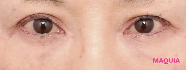 茶くまにおすすめの美容医療の治療 ヒアルロン酸注入 アフター 3か月後