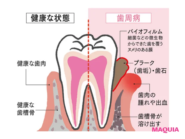 歯周病 健康な状態との比較