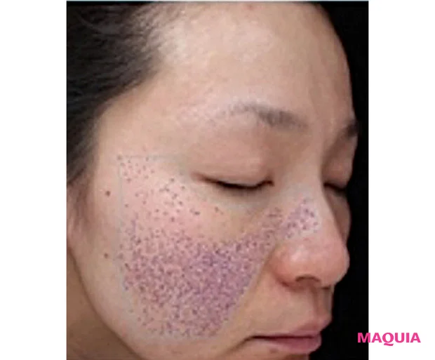 肌温度40℃で老化が加速!? 夏の皮脂テカ、毛穴に差がつく“冷スキンケア”を始めよう_6