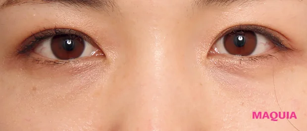 紫くまにおすすめの美容医療の治療 ベビーコラーゲン注射 アフター 1か月後