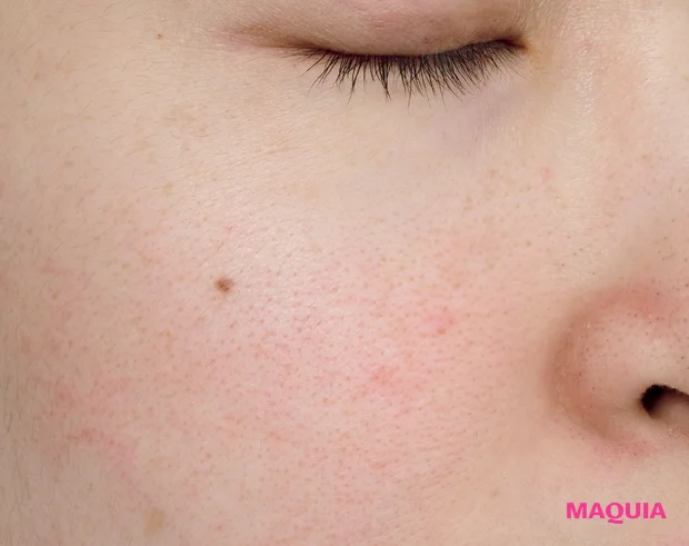 炎症による「ダメージ毛穴」は鎮静が最優先! ビタミンCのシートマスクも有効_7_2