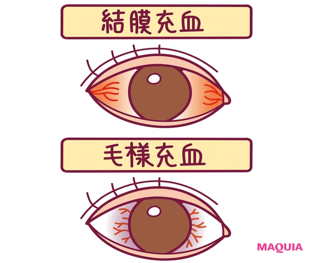 結膜充血と毛様充血