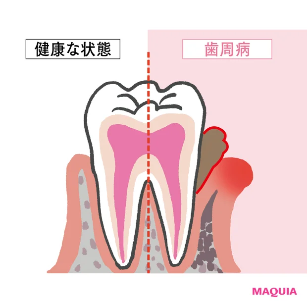 【40代からの歯活】歯周病はエアロゾルや唾液でも感染? 治療の最前線を解…