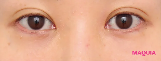 茶くまにおすすめの美容医療の治療 ハムラ法 アフター 3か月後