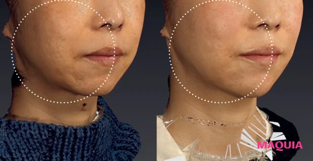 「ポテンツァ」「ボルニューマ」ほか、美容医療の最新トレンドを深掘り。費用やダウンタイムも調査
_3