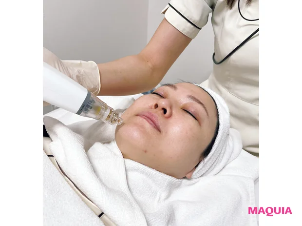 毛穴に効く美容医療は? エステの毛穴吸引ケアって肌によくない? 毛穴の噂に友利先生がアンサー_3