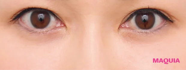 たるみくまにおすすめの美容医療の治療 下眼瞼脱脂術（結膜側） 下眼瞼脂肪注入 アフター 3か月後