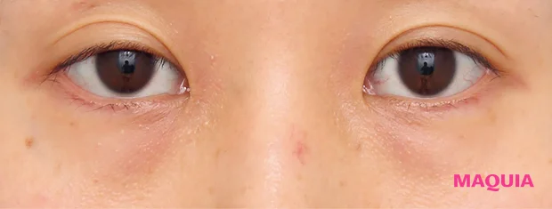 茶くまにおすすめの美容医療の治療 ハムラ法 ビフォー