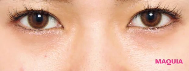 茶くまにおすすめの美容医療の治療 スキンリファインピーリング ビフォー