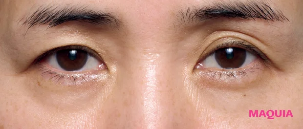 黒ぐま×たるみぐまタイプのくまカバー＆涙袋メイクのテクニック ビフォー