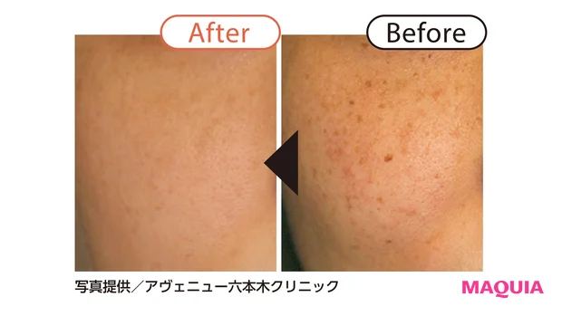 Before/After